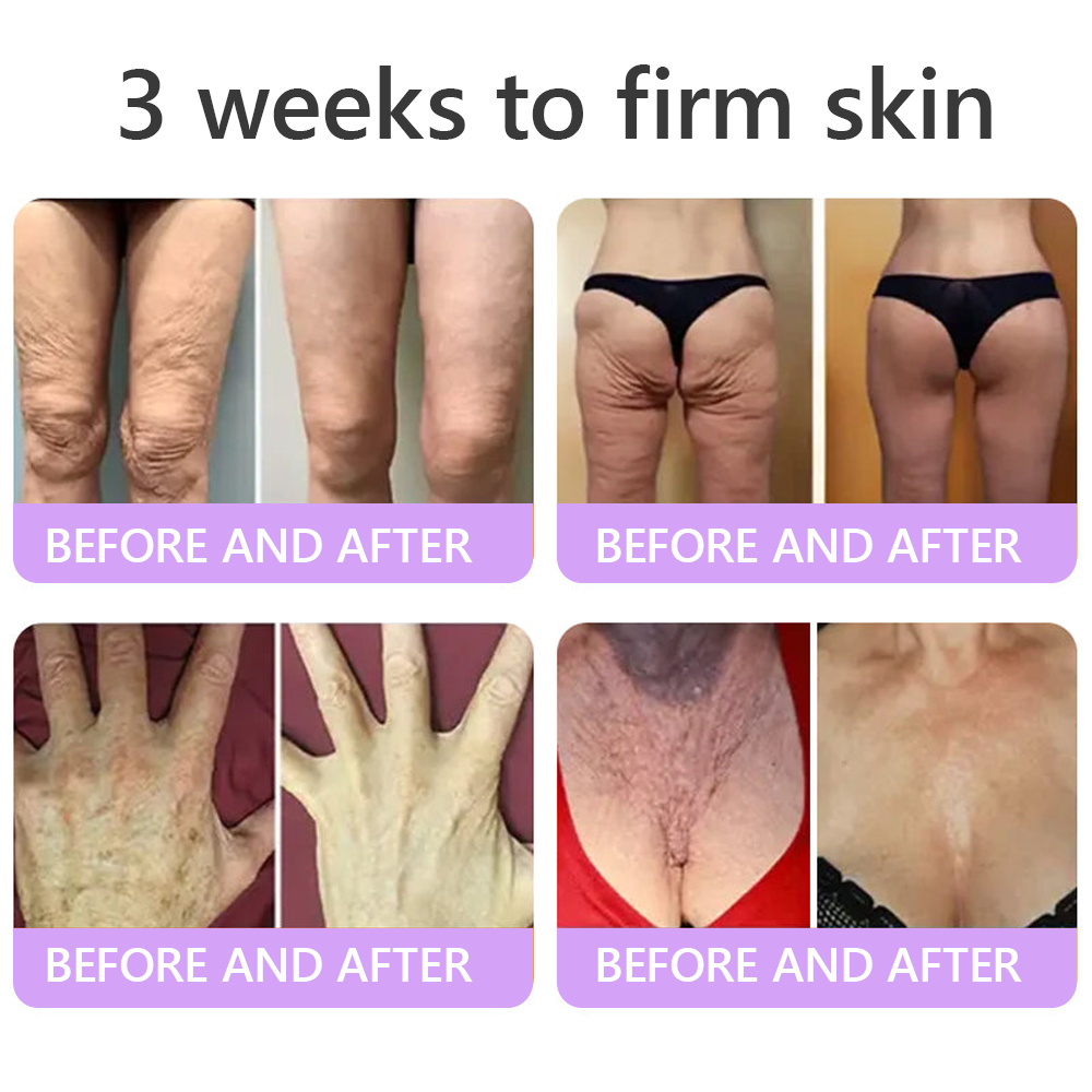 Enjoy an exclusive 30% discount:Vitalisys® 🍈PDRN Multi-Peptide Massaging Body Roller Cream- Anti-aging, Hydrating, Skin Firming & Lifting, Skin Repair, Even Tone, Acne and Dark Spot Treatment, Wart and Mole Removal, and Psoriasis Relief.