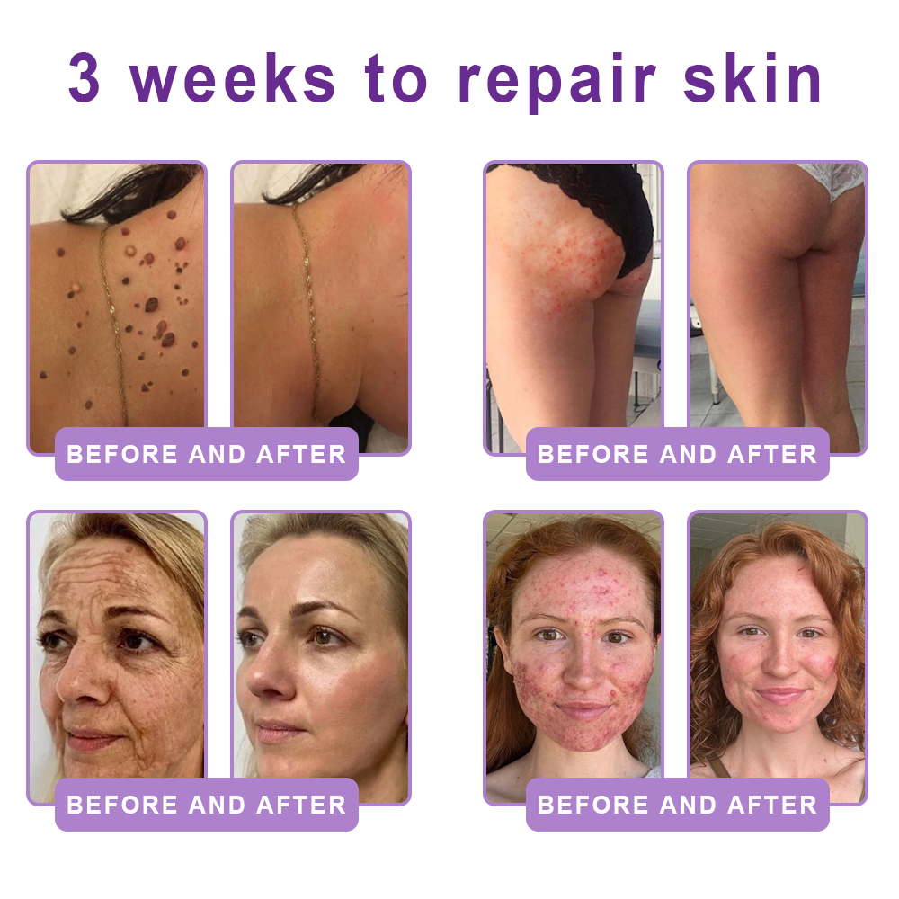 Enjoy an exclusive 30% discount:Vitalisys® 🍈PDRN Multi-Peptide Massaging Body Roller Cream- Anti-aging, Hydrating, Skin Firming & Lifting, Skin Repair, Even Tone, Acne and Dark Spot Treatment, Wart and Mole Removal, and Psoriasis Relief.