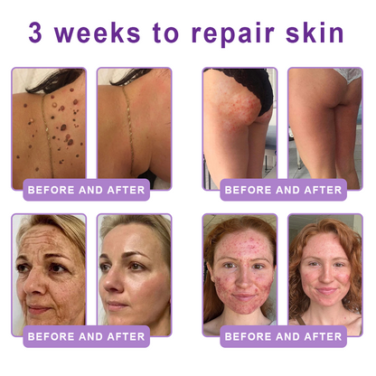 Enjoy an exclusive 30% discount:Vitalisys® 🍈PDRN Multi-Peptide Massaging Body Roller Cream- Anti-aging, Hydrating, Skin Firming & Lifting, Skin Repair, Even Tone, Acne and Dark Spot Treatment, Wart and Mole Removal, and Psoriasis Relief.
