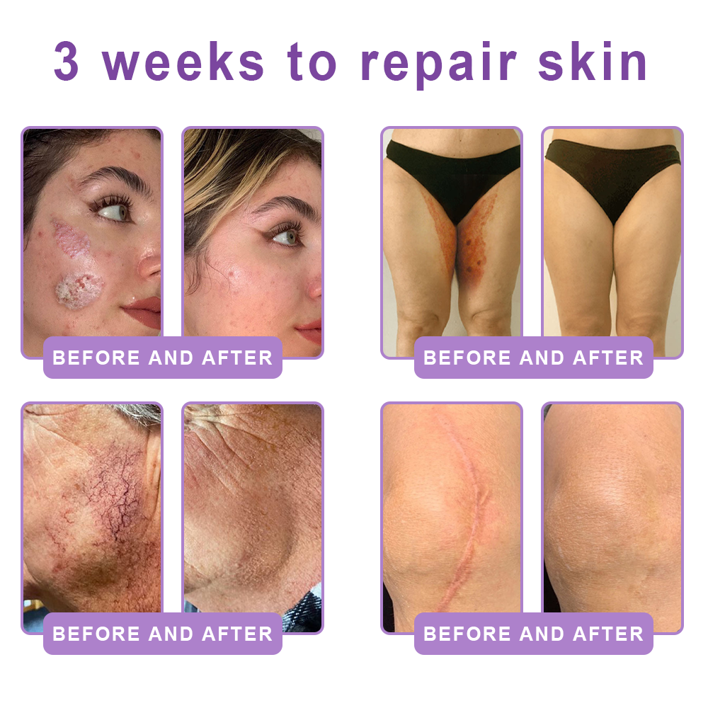 Enjoy an exclusive 30% discount:Vitalisys® 🍈PDRN Multi-Peptide Massaging Body Roller Cream- Anti-aging, Hydrating, Skin Firming & Lifting, Skin Repair, Even Tone, Acne and Dark Spot Treatment, Wart and Mole Removal, and Psoriasis Relief.