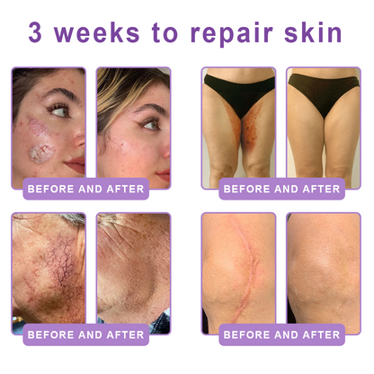 Enjoy an exclusive 30% discount:Vitalisys® 🍈PDRN Multi-Peptide Massaging Body Roller Cream- Anti-aging, Hydrating, Skin Firming & Lifting, Skin Repair, Even Tone, Acne and Dark Spot Treatment, Wart and Mole Removal, and Psoriasis Relief.
